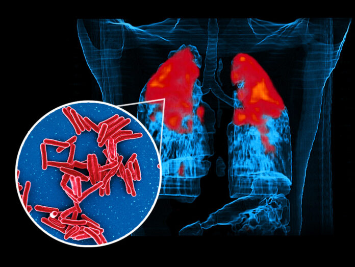 tuberculosis