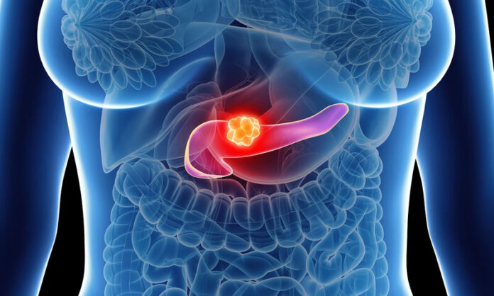 pancreatic_cancer